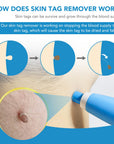 MicroCare Skin Solution - Advanced Skin Tag, Wart, Acne, and Pimple Removal Kit