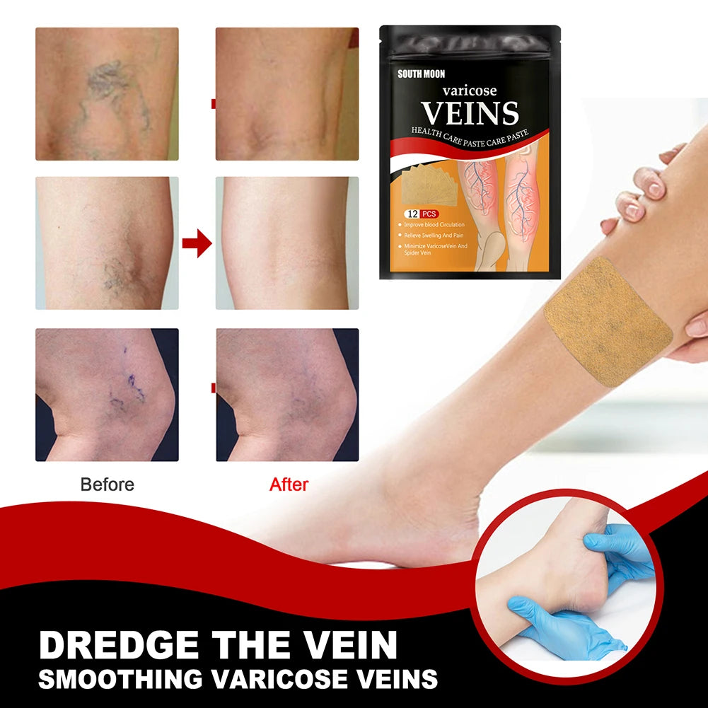 Kenko Spider &amp; Varicose Vein Patches | Natural Herbal