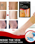 Kenko Spider & Varicose Vein Patches | Natural Herbal