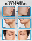 Derma Stamp 140A Micro Needling Tool For Hair, Skin And Acne