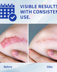 Silicone Scar Cream for Old and New Scars