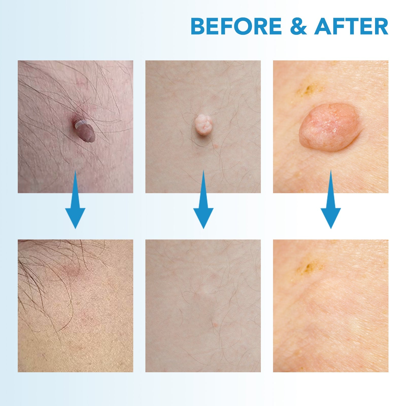 MicroCare Skin Solution - Advanced Skin Tag, Wart, Acne, and Pimple Removal Kit