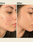 Derma Stamp 140A Micro Needling Tool For Hair, Skin And Acne