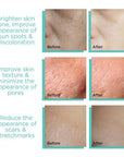Derma Stamp 140A Micro Needling Tool For Hair, Skin And Acne