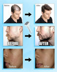 Derma Stamp 140A Micro Needling Tool For Hair, Skin And Acne