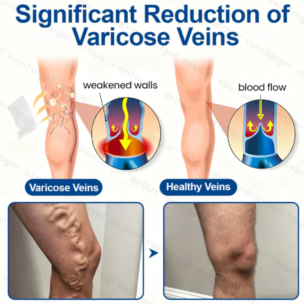 Varicose VeinTarget Microneedle Patch
