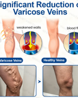 Varicose VeinTarget Microneedle Patch