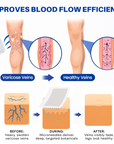 Varicose VeinTarget Microneedle Patch